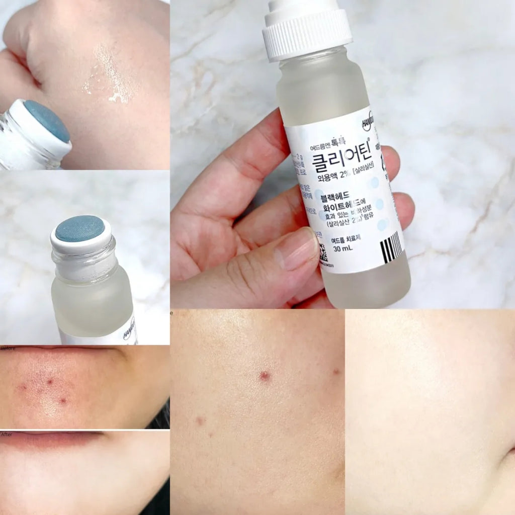 HANDOK Clearteen 30ml Acne Blackhead Whitehead Spot Treatment BHA Early Acne Trouble Care / from Seoul, Korea