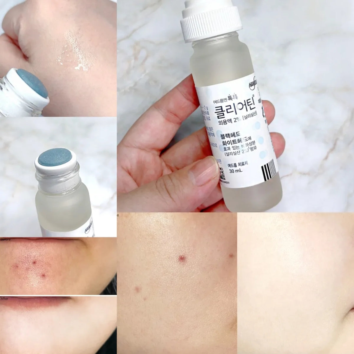HANDOK Clearteen 30ml Acne Blackhead Whitehead Spot Treatment BHA Early Acne Trouble Care / from Seoul, Korea