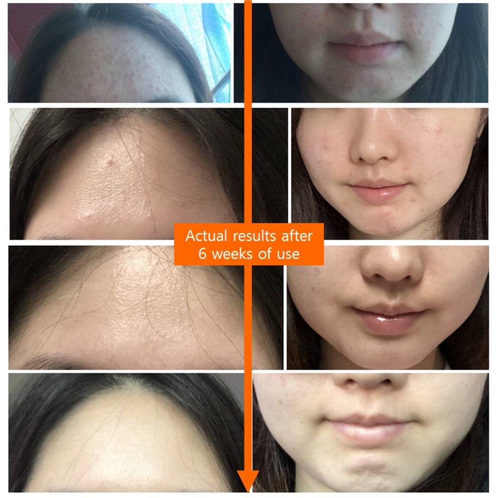 HANDOK Clearteen 30ml Acne Blackhead Whitehead Spot Treatment BHA Early Acne Trouble Care / from Seoul, Korea