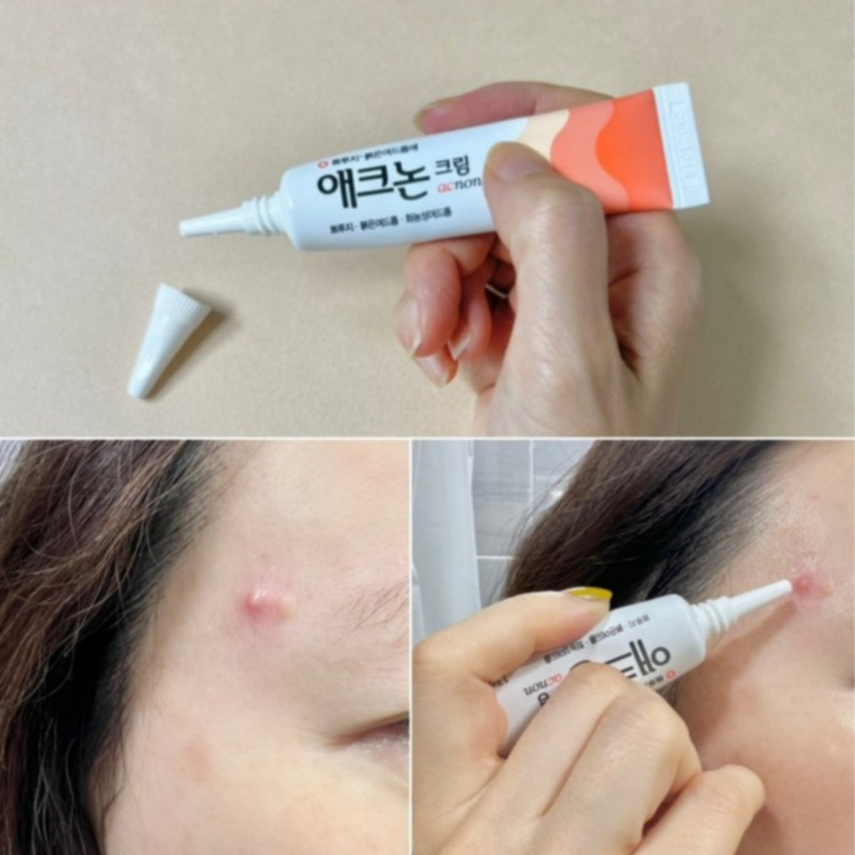 DONG-A Acnon Cream 13g Acne Care Treatment Pimples, Purulent Acne, No Antibiotics, No Steroids, Direct shipping from Seoul to Singapore
