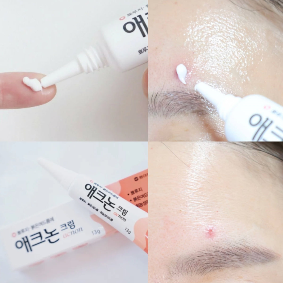DONG-A Acnon Cream 13g Acne Care Treatment Pimples, Purulent Acne, No Antibiotics, No Steroids, Direct shipping from Seoul to Singapore