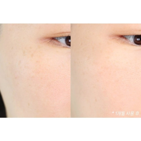 DONG-A MelaToning Cream 30g Freckles, Senile Dark Spots, Melanin Pigmentation, Acne Area / from Seoul, Korea